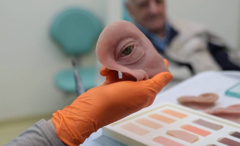 Paraná tem prótese facial pelo SUS que simula até as manchas da pele