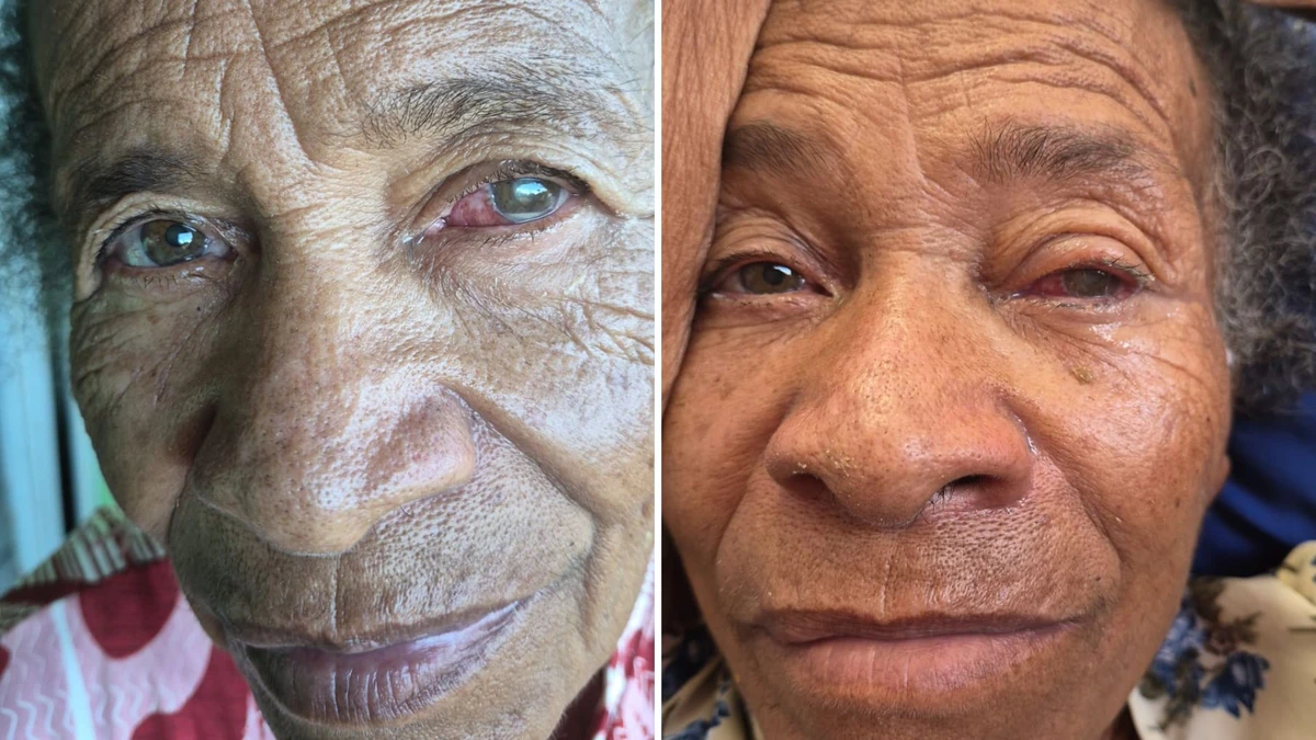 Mutirão oftalmológico deixa idosa cega de um olho na Bahia